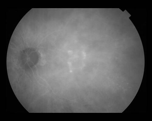 Wall Art - Photograph - Wet Macular Degeneration by Paul Whitten