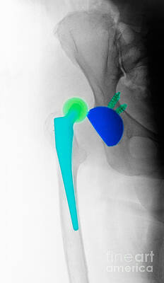 Wall Art - Photograph - X-ray Showing Hip Dislocation by Scott Camazine