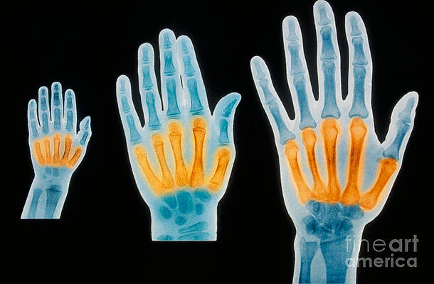 Wall Art - Photograph - X-rays Of 2 Year Old, 7 Year Old by Scott Camazine & Sue Trainor