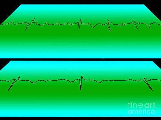 Wall Art - Photograph - Atrial Flutter & Normal Heart Beat #1 by Science Source