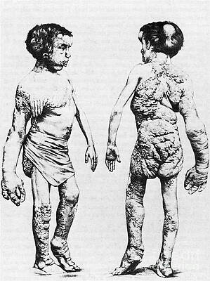 Wall Art - Photograph - Joseph Merrick, The Elephant Man #1 by Science Source