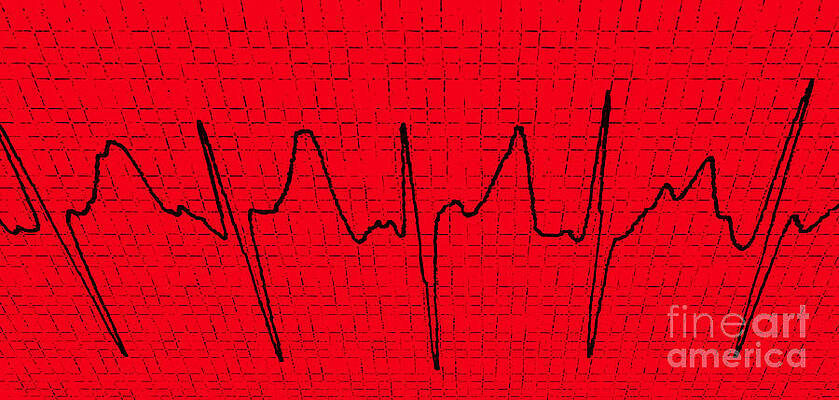 Wall Art - Photograph - Atrial Fibrillation #2 by Science Source