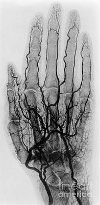 Wall Art - Photograph - Hand Arteriogram #5 by Science Source