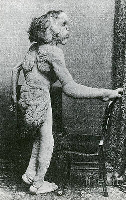 Wall Art - Photograph - Joseph Merrick, The Elephant Man #2 by Science Source