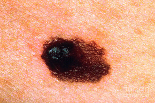 Wall Art - Photograph - Melanoma #2 by Science Source