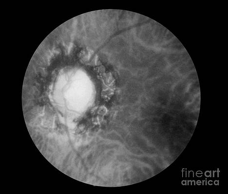 Wall Art - Photograph - Retina Infected By Syphilis #2 by Science Source