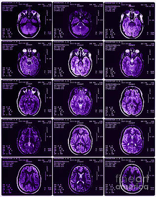Wall Art - Photograph - Mri Of Normal Brain #27 by Science Source
