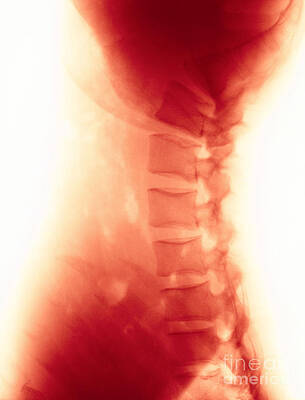 Wall Art - Photograph - Compression In Lumbar Vertebrae #3 by Science Source