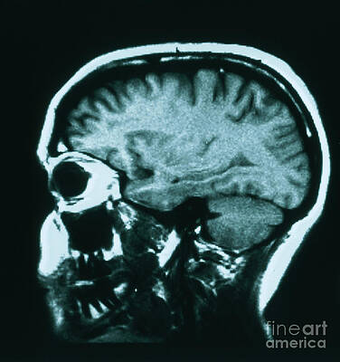 Wall Art - Photograph - Mri Of Normal Brain #4 by Science Source