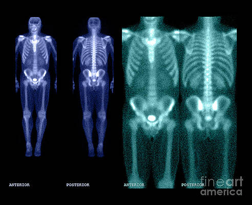 Wall Art - Photograph - Bone Scan #7 by Medical Body Scans