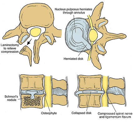 Wall Art - Photograph - Illustration Of Spinal Disk Pathologies #9 by Science Source