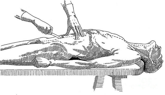 Wall Art - Photograph - A Handbook Of Morbid Anatomy by Science Source