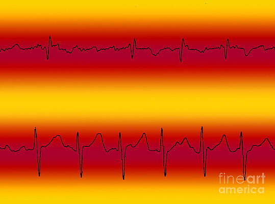 Wall Art - Photograph - Atrial Flutter & Atrial Fibrillation by Science Source