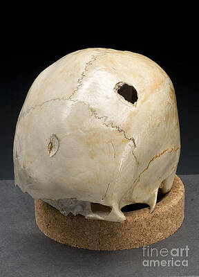 Wall Art - Photograph - Blunt Force Hammer Trauma To Skull by Science Source