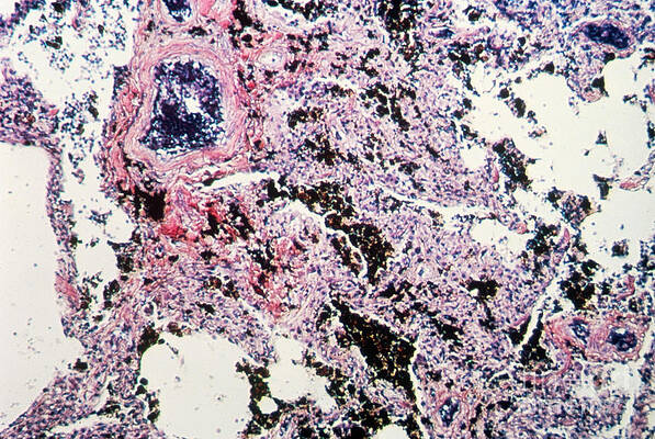 Wall Art - Photograph - Carbon Deposits In Lung Tissue by Science Source