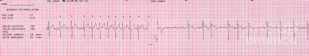 Wall Art - Photograph - Cardioversion, 1 Of 2 by Science Source