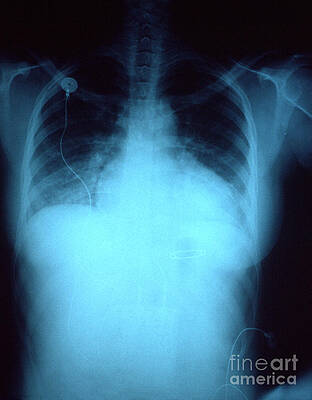 Wall Art - Photograph - Congestive Heart Failure by Science Source