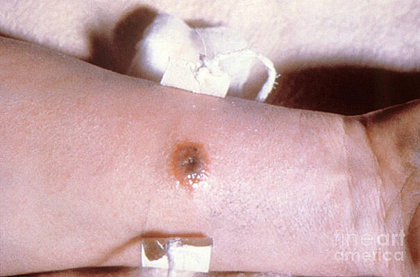 Wall Art - Photograph - Cutaneous Anthrax by Science Source