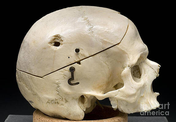 Wall Art - Photograph - Gunshot Trauma To Skull, 1950s by Science Source
