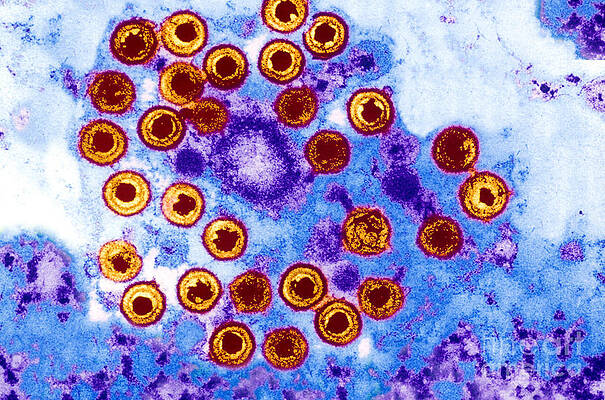 Wall Art - Photograph - Herpes Simplex by Science Source