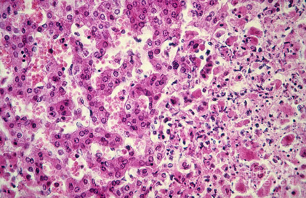 Wall Art - Photograph - Herpes Simplex Virus Lm by AFIP/Science Source