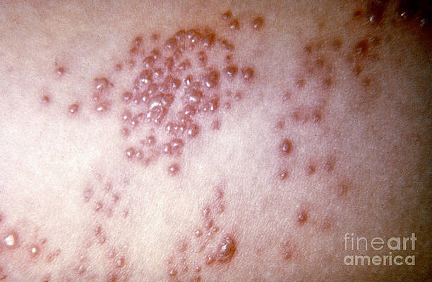 Wall Art - Photograph - Herpes Simplex Virus by Science Source