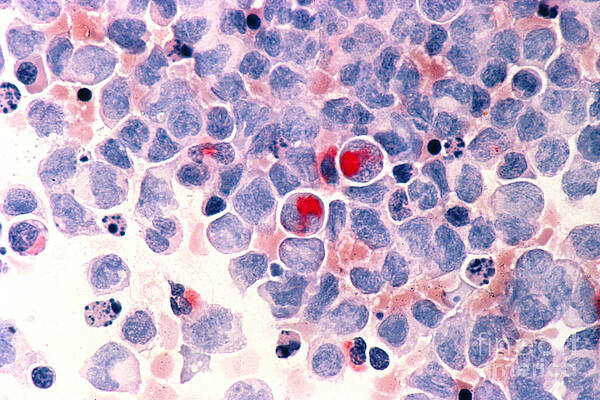 Wall Art - Photograph - Myelocytic Leukemia by Science Source
