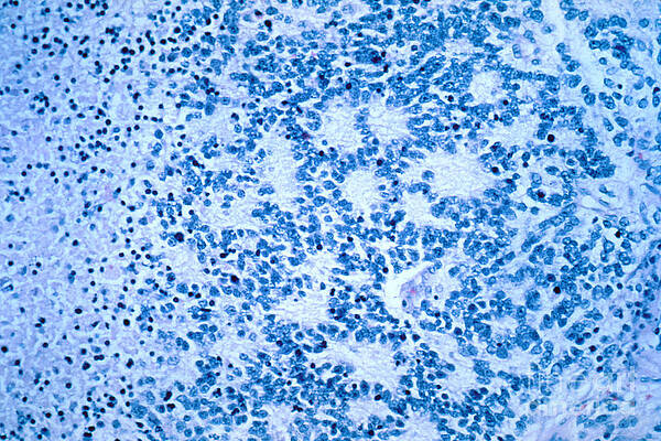 Wall Art - Photograph - Neuroblastoma by Science Source