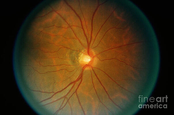Wall Art - Photograph - Retina, Lupus Patient by Science Source