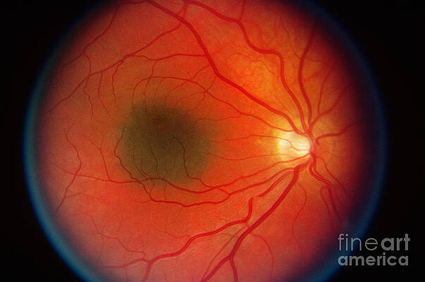 Wall Art - Photograph - Nevus In The Retina by Science Source