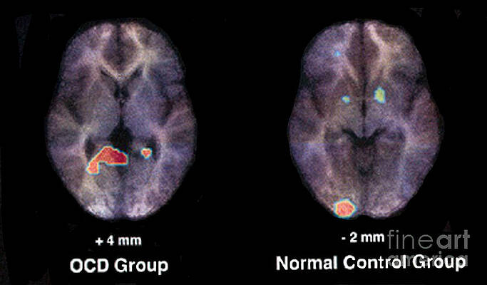 Wall Art - Photograph - Pet Scan, Normal And Ocd Brain by Science Source