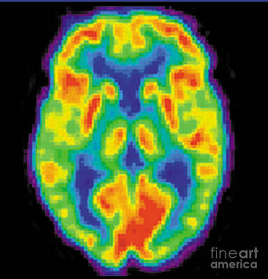 Wall Art - Photograph - Pet Scan Of 20-year-old Brain by Science Source