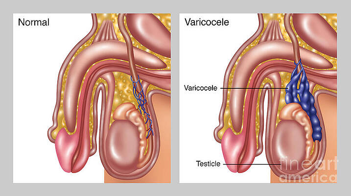 Wall Art - Photograph - Scrotal Varicocele, Illustration by Gwen Shockey