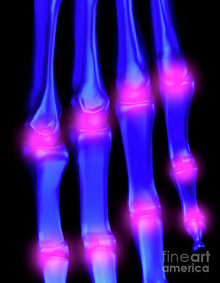 Wall Art - Photograph - Computer Artwork Of Arthritis Affecting Fingers #1 by Science Photo Library