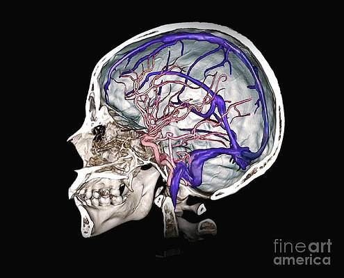Wall Art - Photograph - Brain Arteries And Venous Sinuses #4 by Science Photo Library