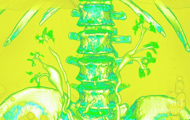 Wall Art - Photograph - Kidneys And Duplicated Ureter #8 by Science Photo Library