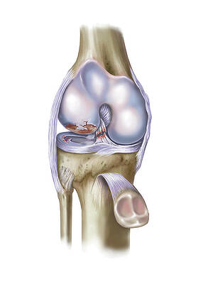 Wall Art - Photograph - Front View Of Knee Showing Torn Acl by Elise Walmsley Mac-Wha