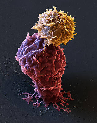 Wall Art - Photograph - Leukemia Cell With Car T-cell, Sem by Eye of Science