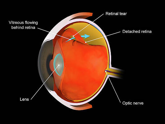 Medical Illustration Of A Detached by Stocktrek Images Medical Illustration Of A Detached by Stocktrek Images
