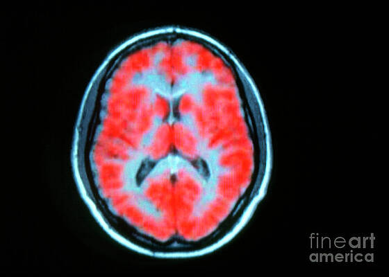 Wall Art - Photograph - Pet Scan Of Brain Activity On Mri by Science Photo Library