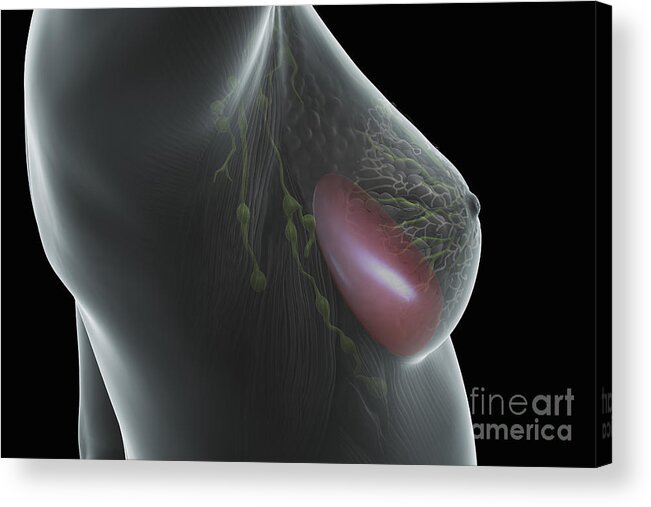 3d Visualisation Acrylic Print featuring the photograph Breast Implant #2 by Science Picture Co