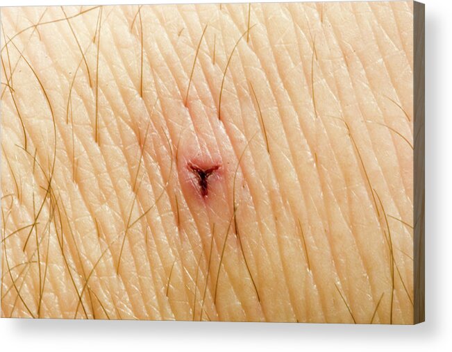 Bite On Human Skin From Medicinal Leech Acrylic Print by Science