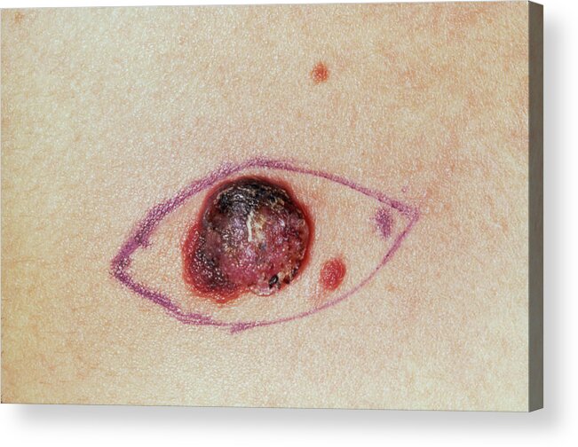 Melanoma Acrylic Print featuring the photograph Close Up Of A Malignant Melanoma Before Excision by James Stevenson/science Photo Library