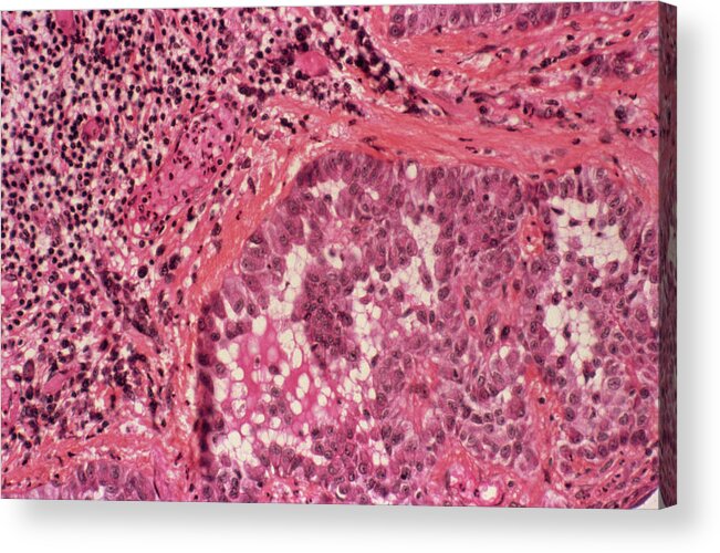 Mesothelioma Acrylic Print featuring the photograph Mesothelioma Cancer by Cnri/science Photo Library