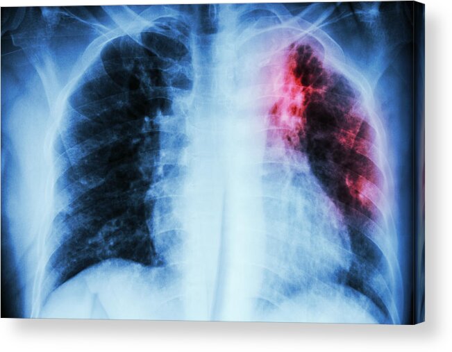 Pneumonia Acrylic Print featuring the photograph Pulmonary Tuberculosis by Stockdevil