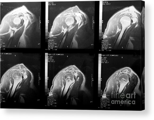 Rotator Cuff Acrylic Print featuring the photograph MRI of Rotator Cuff by Karen Foley