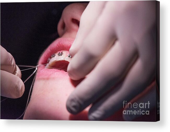 Boy Acrylic Print featuring the photograph Boy Having Orthodontic Brace Fitted #1 by Andy Davies/science Photo Library