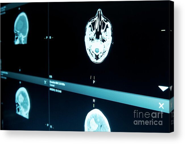Brain Acrylic Print featuring the photograph Mri Brain Scans by Science Photo Library