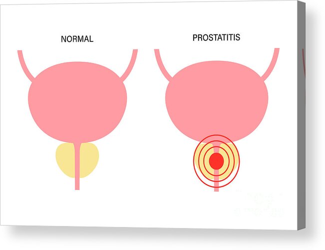 Prostatitis Acrylic Print featuring the photograph Prostatitis by Pikovit / Science Photo Library