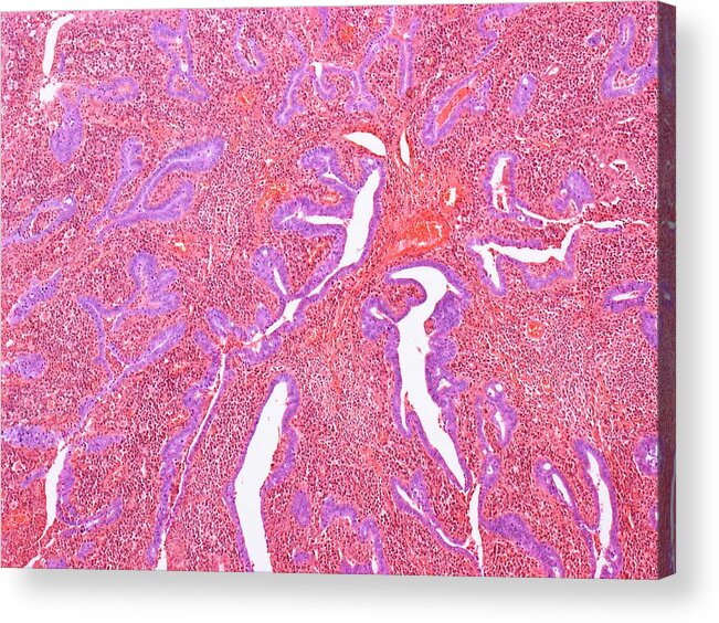 Salpingitis Acrylic Print featuring the photograph Inflamed Fallopian Tube #2 by Steve Gschmeissner